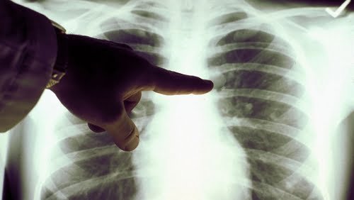  diagnosed lung cancer
