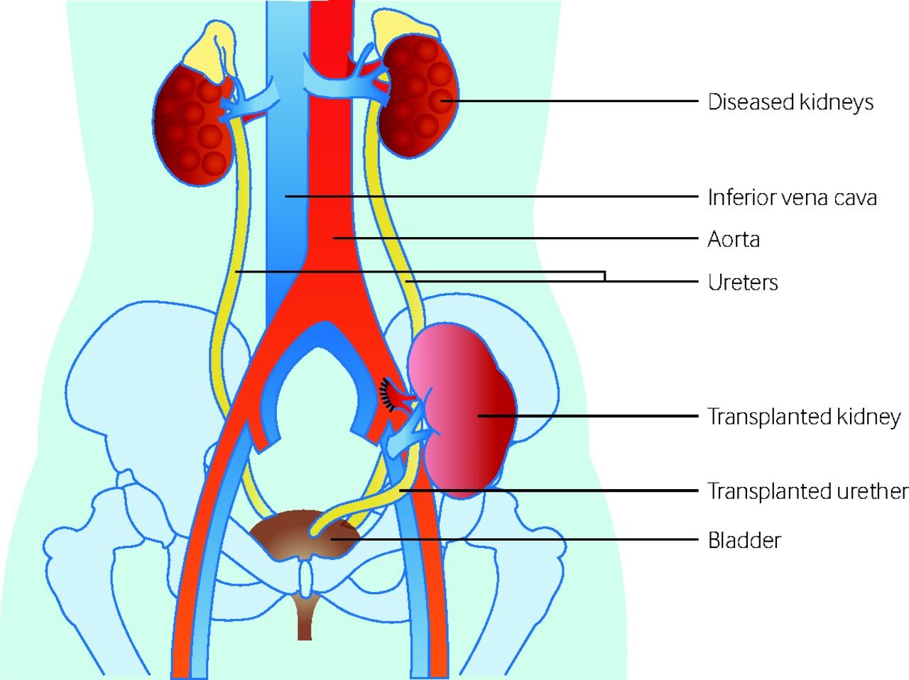 renal transplantation