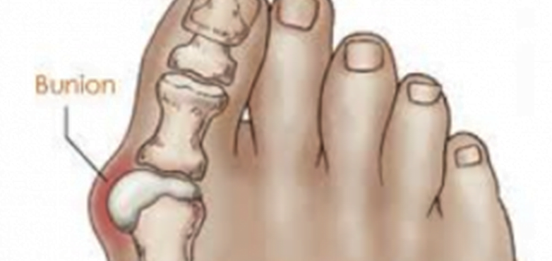 hallux valgus deformity