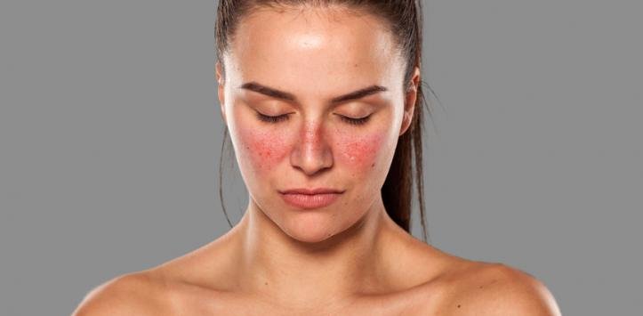 systemic lupus erythematosus