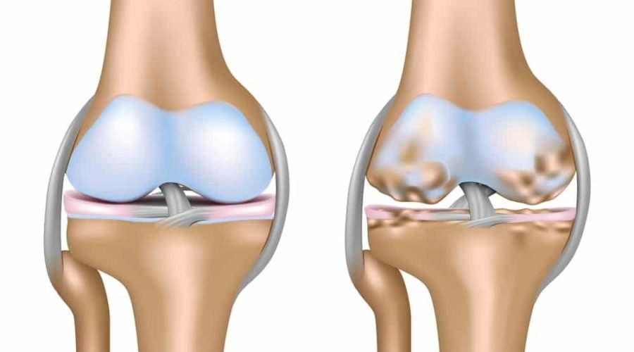 degenerative joint disease