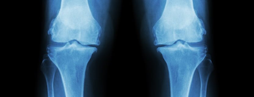 degenerative joint disease