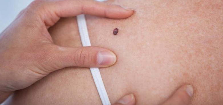 skin cancer