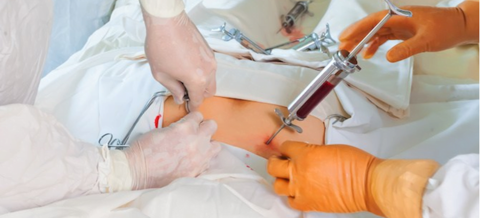 stem cell transplant