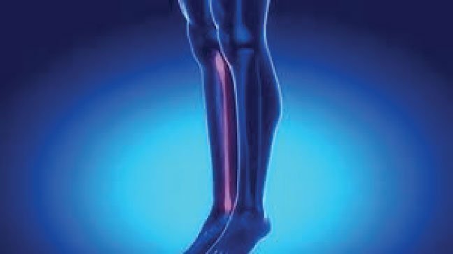 Sprained ankle