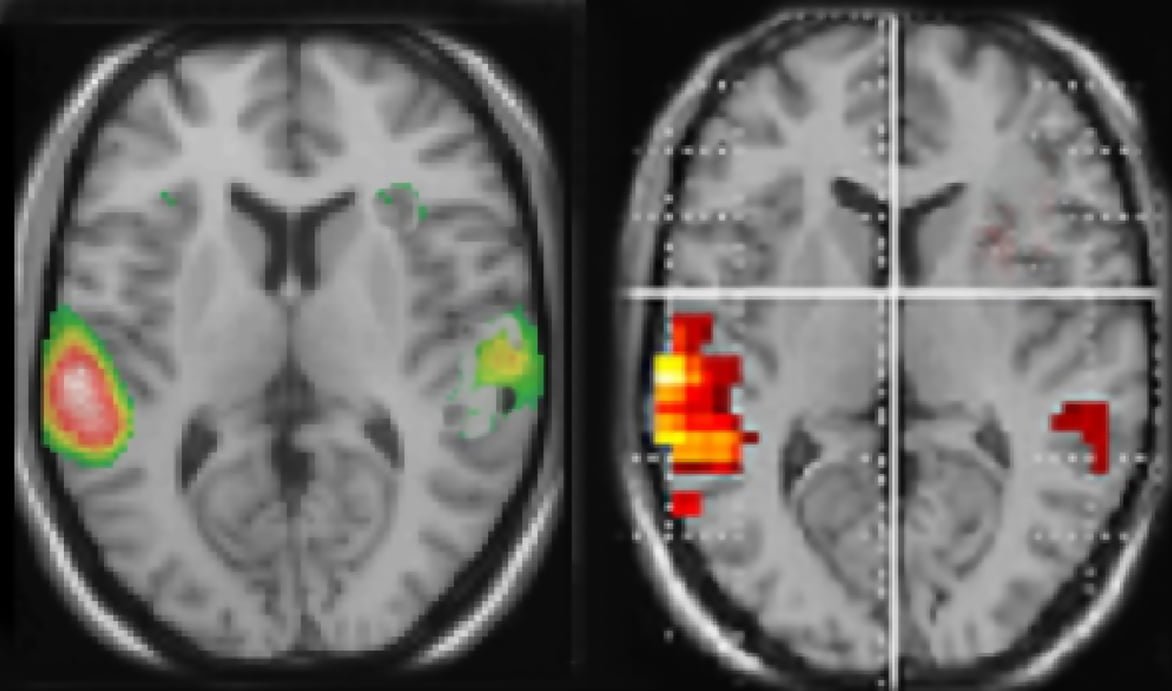 AUDITORY HALLUCINATIONS