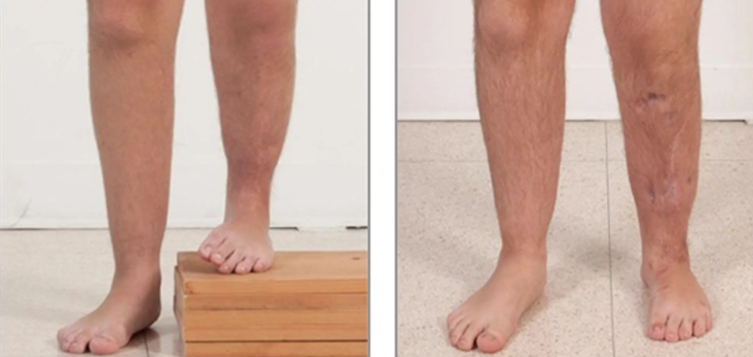 limb lengthening surgery