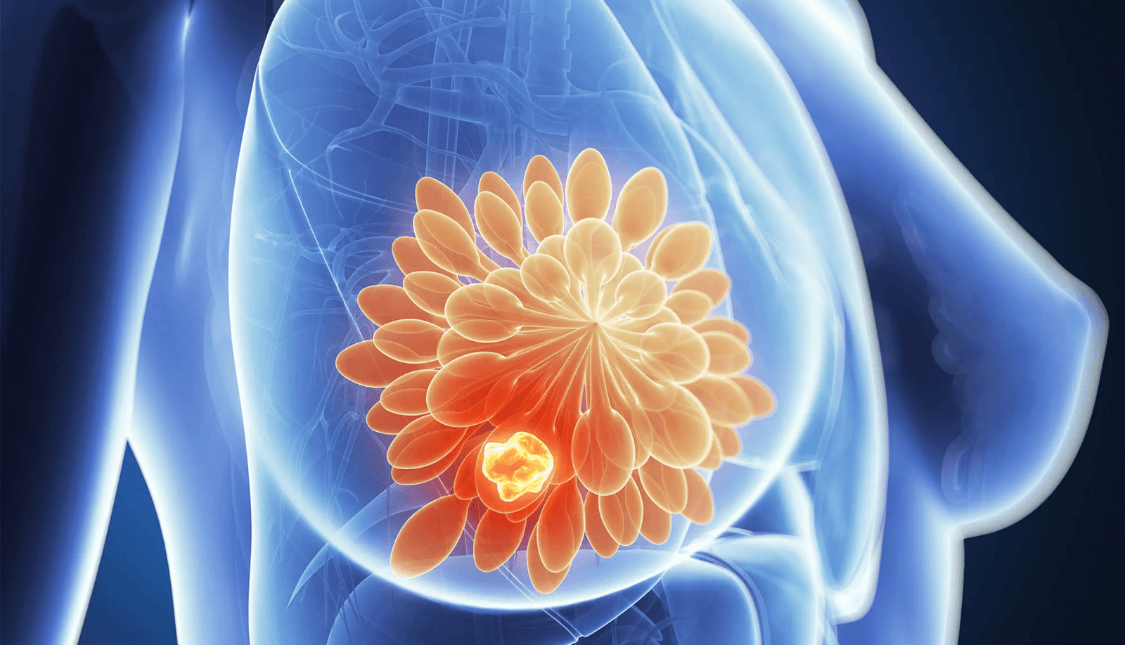 Breast cancer treatment