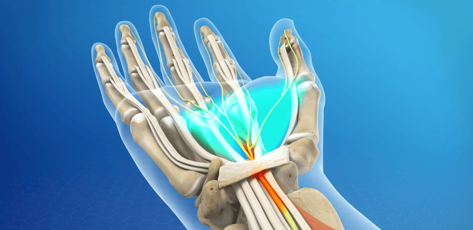 Carpal Tunnel Syndrome