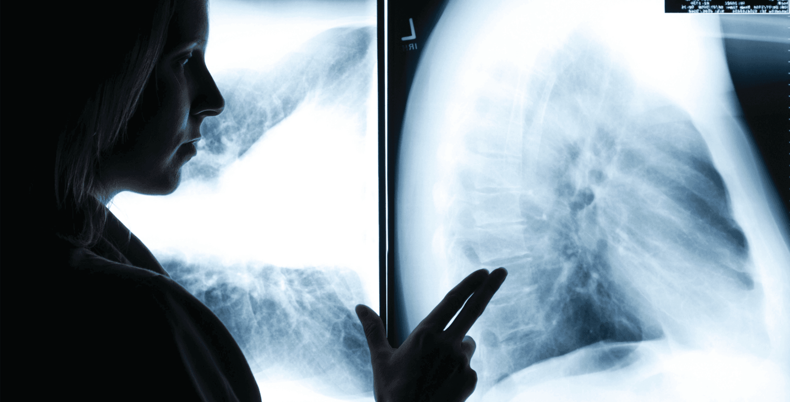 Lung Cancer