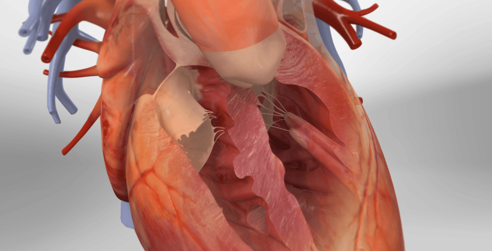 Tetralogy of Fallot