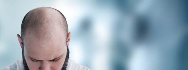 Alopecia treatment