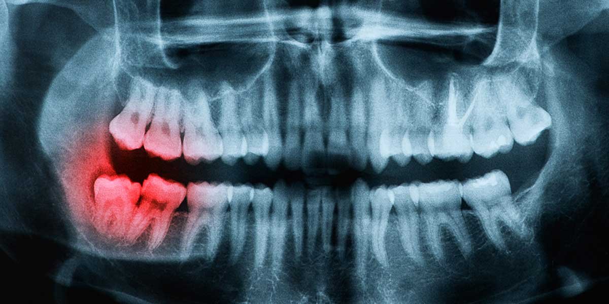 Dentoalveolar Procedures