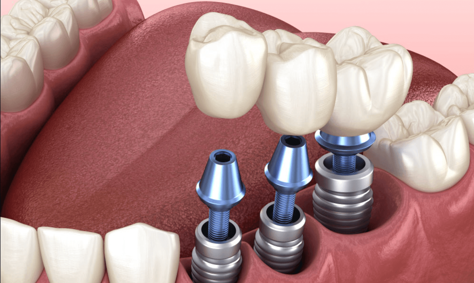 Tooth Replacement